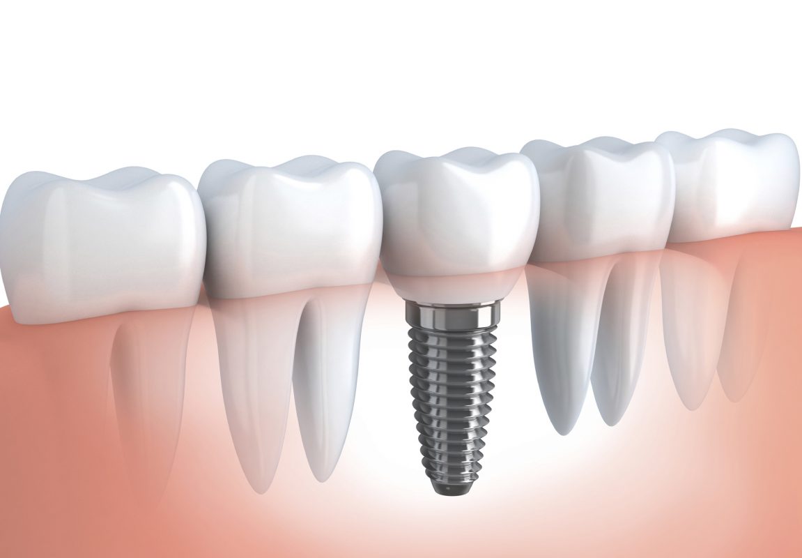 Implantodontia – Consultório Odontológico-Dra Ana Luiza Gomes